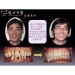 Dental Laser Treatment