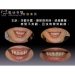 Vollen Mund Zahnimplantate