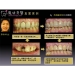 Dental Implants Front Teeth