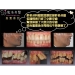 Laser Periodontal Surgery
