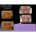 Dental Implant Surgery Recovery