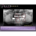Dental Implants Surgery