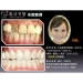 Teeth Whitening Laser