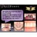 Immediate Dental Implants
