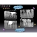 Root Canal Therapy