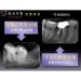 Calcified Root Canal