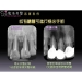 Apical Surgery
