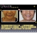 Cosmetic Dental Implants