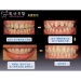 Temporary Crown Dental